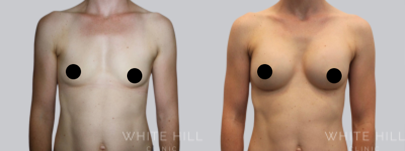 Breast Augmentation before after