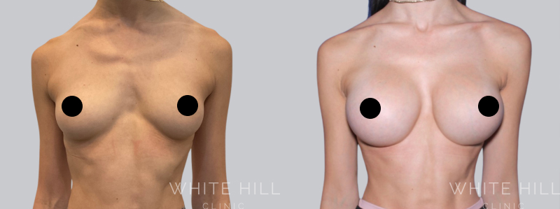 Breast Augmentation before after