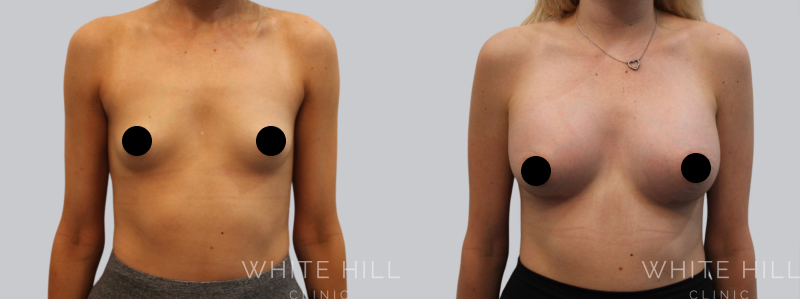 Breast Augmentation before after