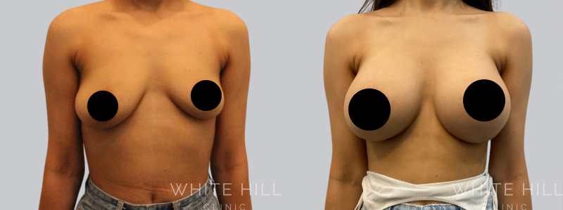 Breast Augmentation before after