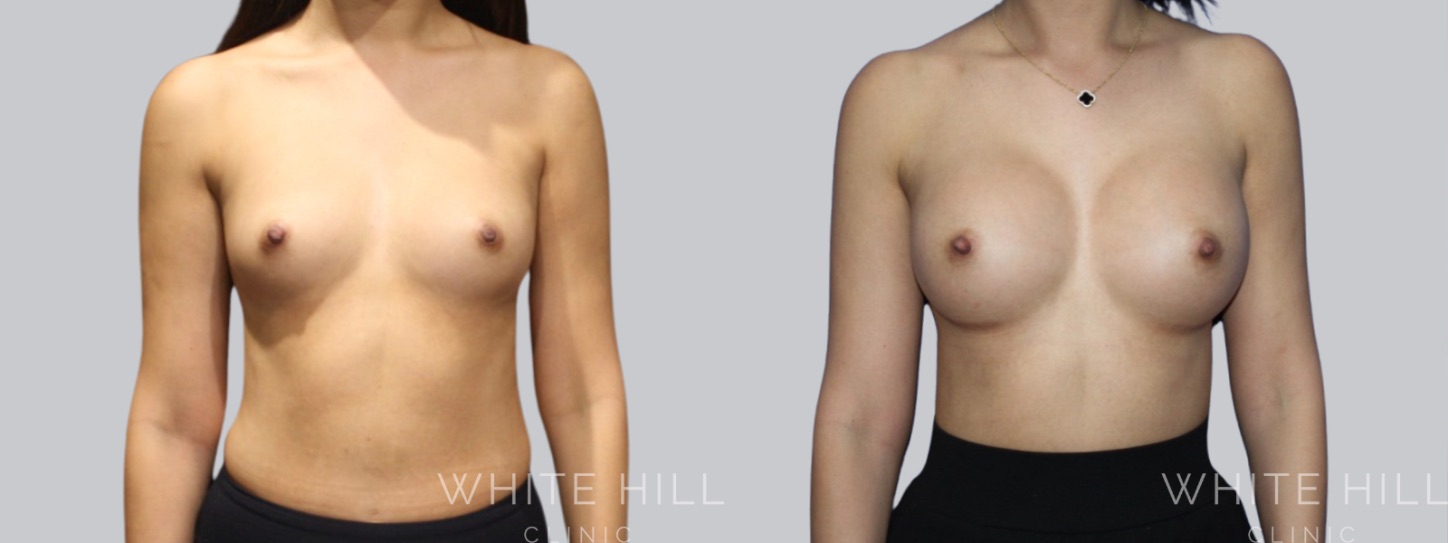 Breast Enhancement Sydney White Hill Clinic