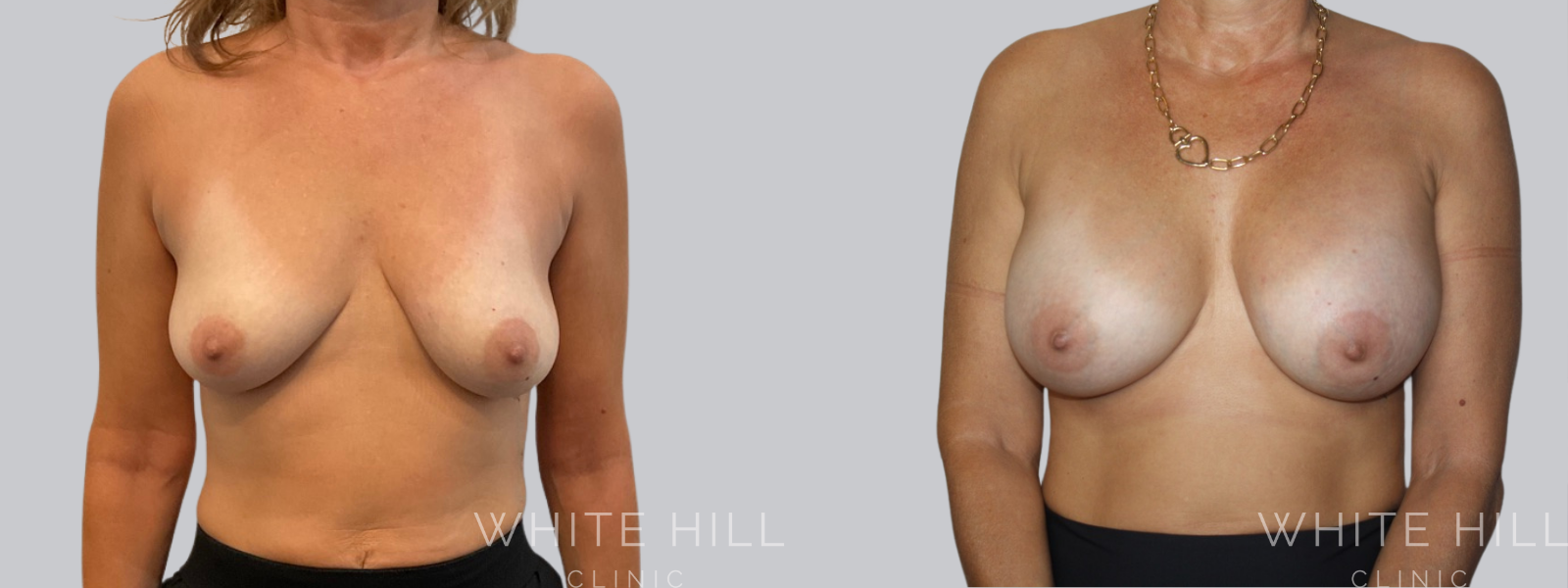 Breast Enhancement Sydney White Hill Clinic