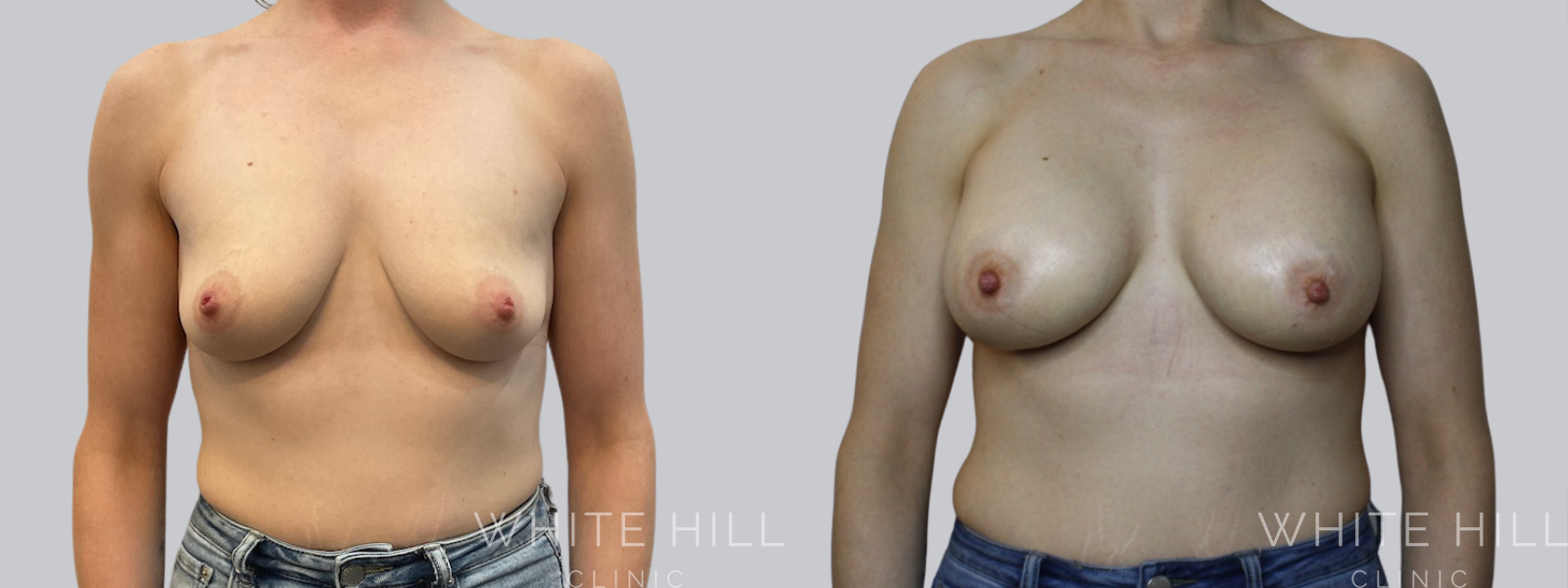 Breast Enhancement Sydney White Hill Clinic