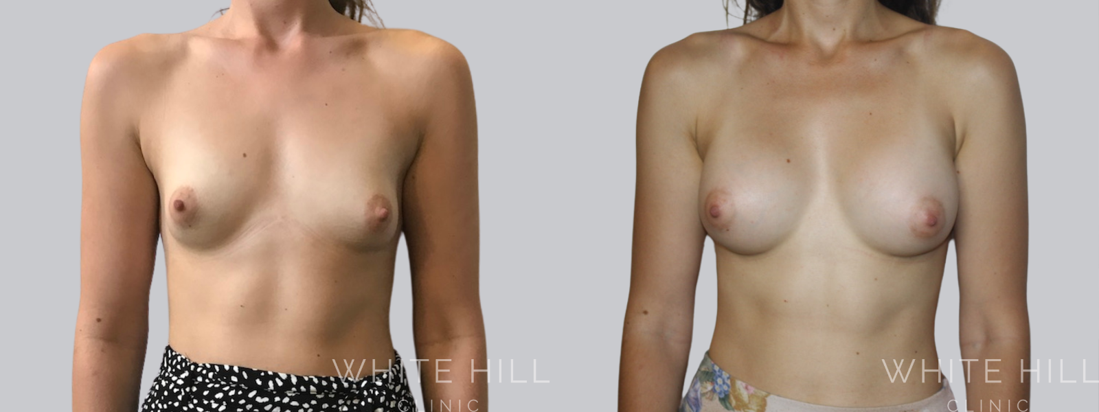 Breast Enhancement Sydney White Hill Clinic