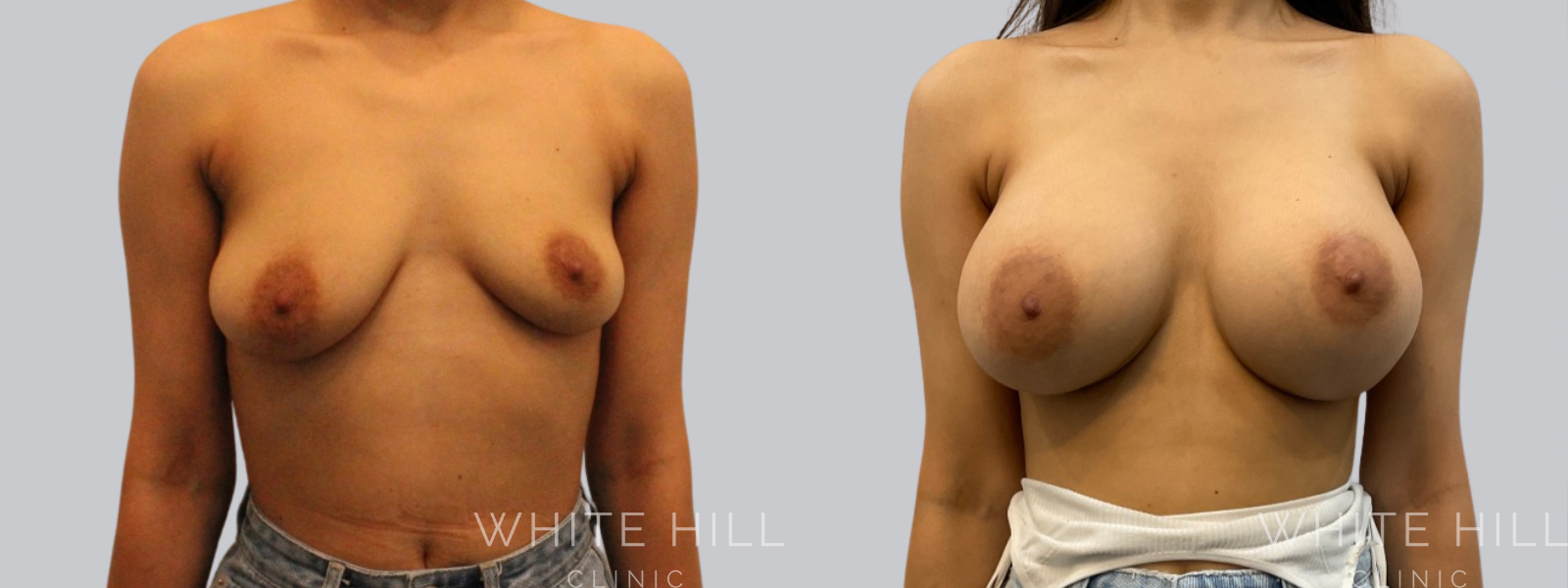 Breast Enhancement Sydney White Hill Clinic