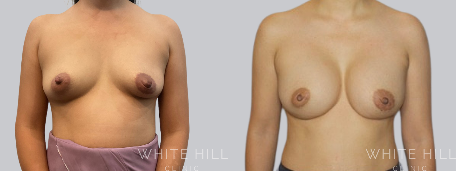 Breast Enhancement Sydney White Hill Clinic