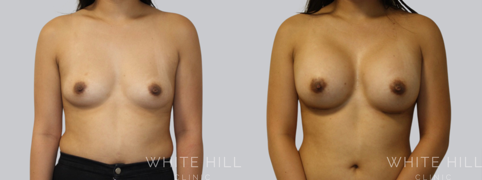 Breast Enhancement Sydney White Hill Clinic