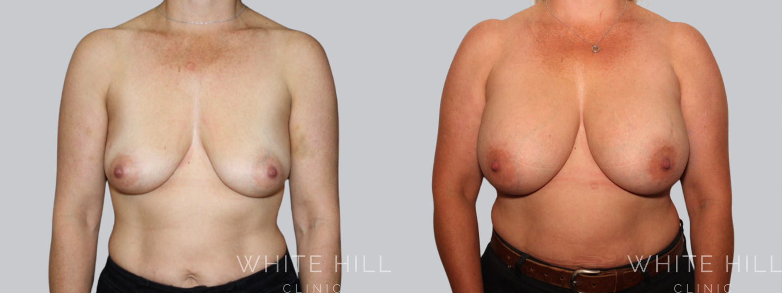 Breast Enhancement Sydney White Hill Clinic