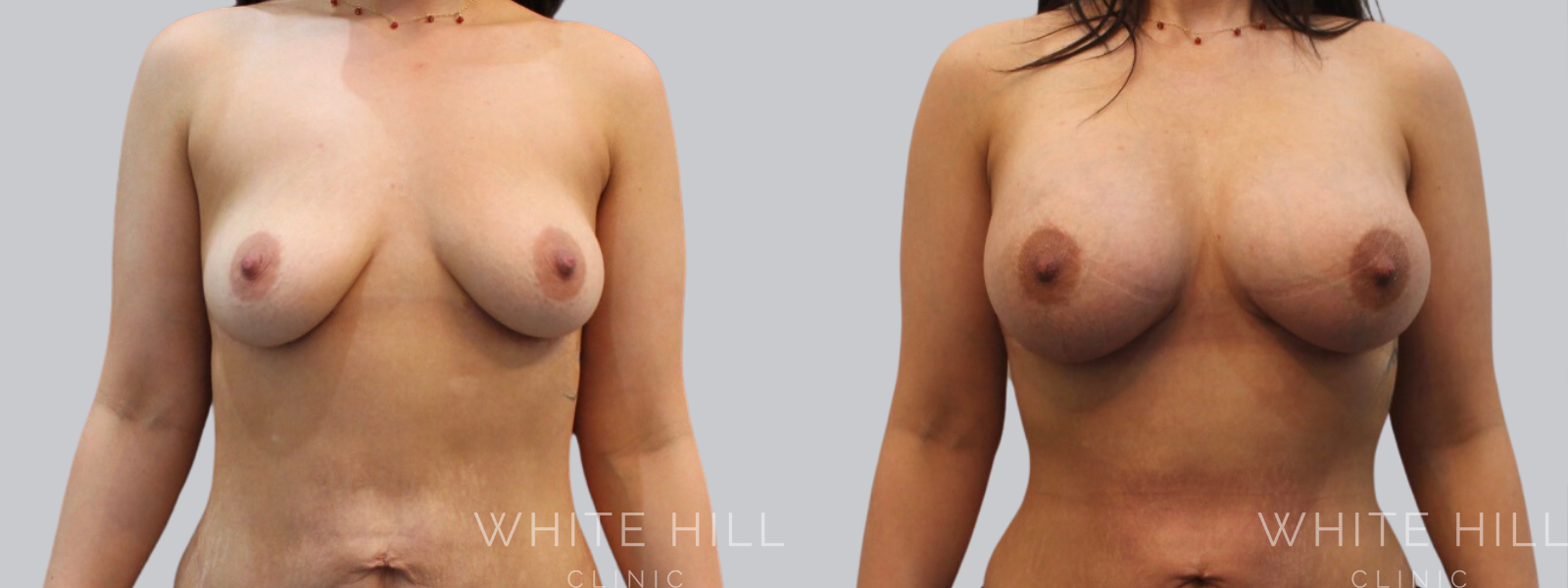 Breast Enhancement Sydney White Hill Clinic