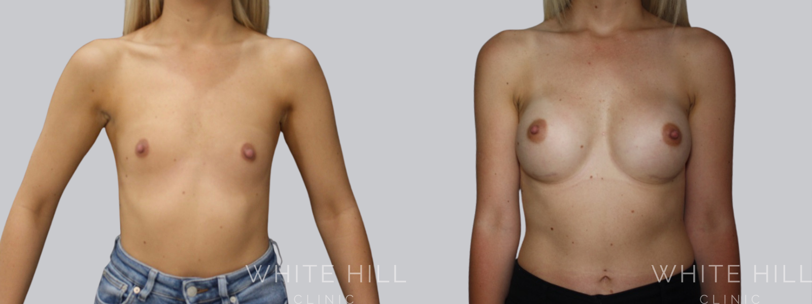 Breast Enhancement Sydney White Hill Clinic