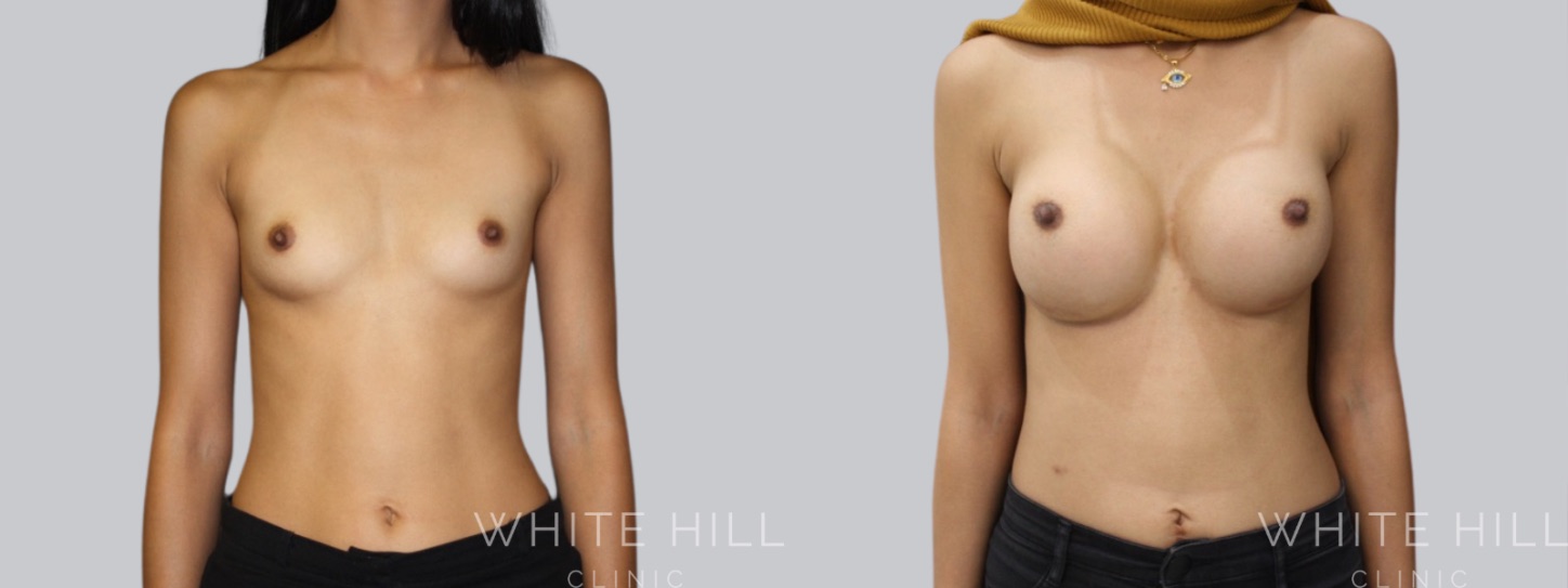 Breast Enhancement Sydney White Hill Clinic