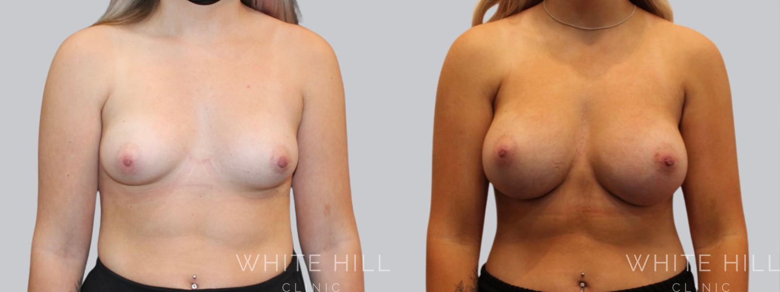 Breast Enhancement Sydney White Hill Clinic