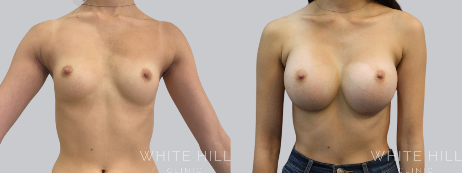 Breast Enhancement Sydney White Hill Clinic