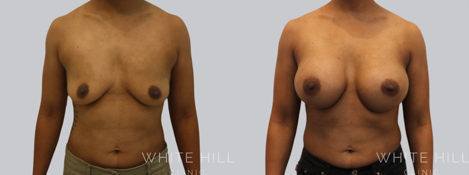 Breast Enhancement Sydney White Hill Clinic