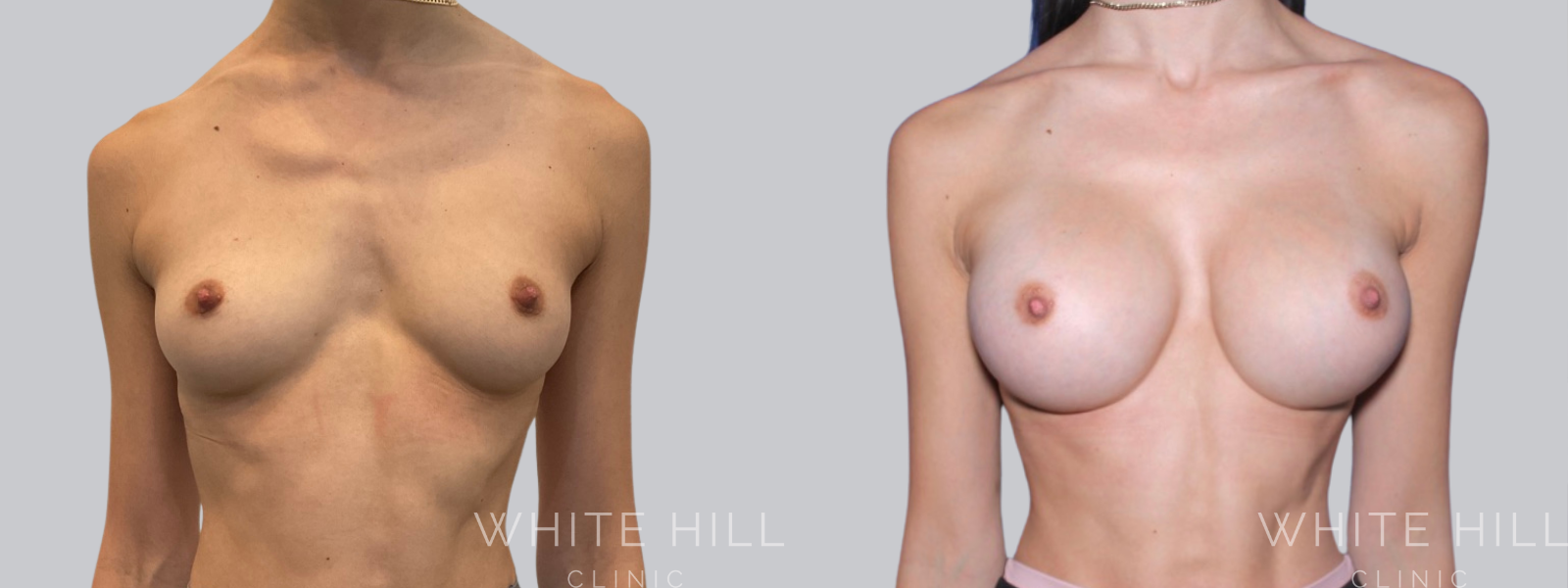 Breast Enhancement Sydney White Hill Clinic