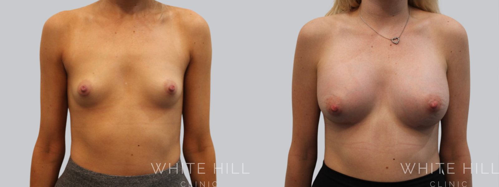 Breast Enhancement Sydney White Hill Clinic