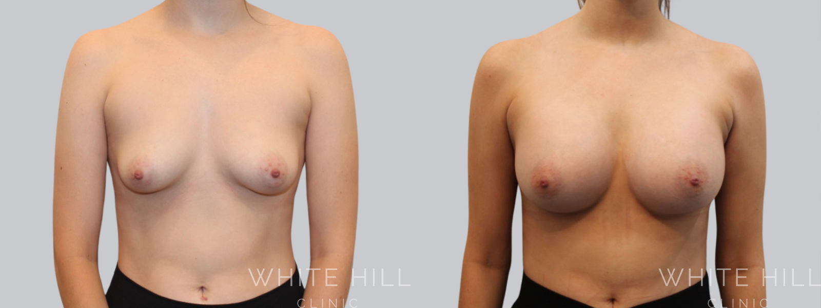 Breast Enhancement Sydney White Hill Clinic