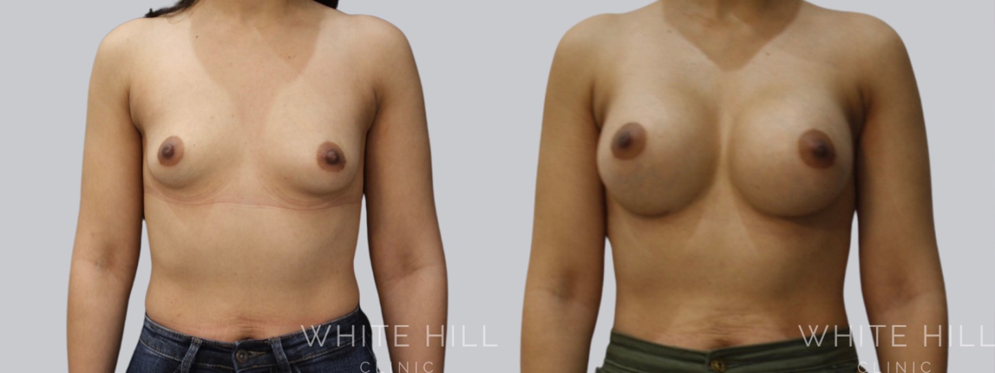 Breast Enhancement Sydney White Hill Clinic