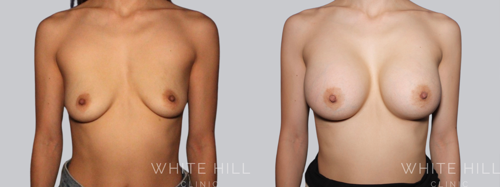 Breast Enhancement Sydney White Hill Clinic