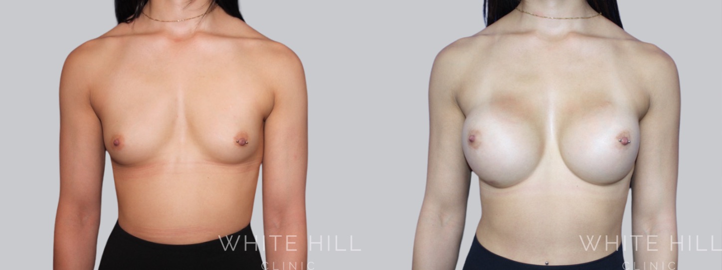 Breast Enhancement Sydney White Hill Clinic