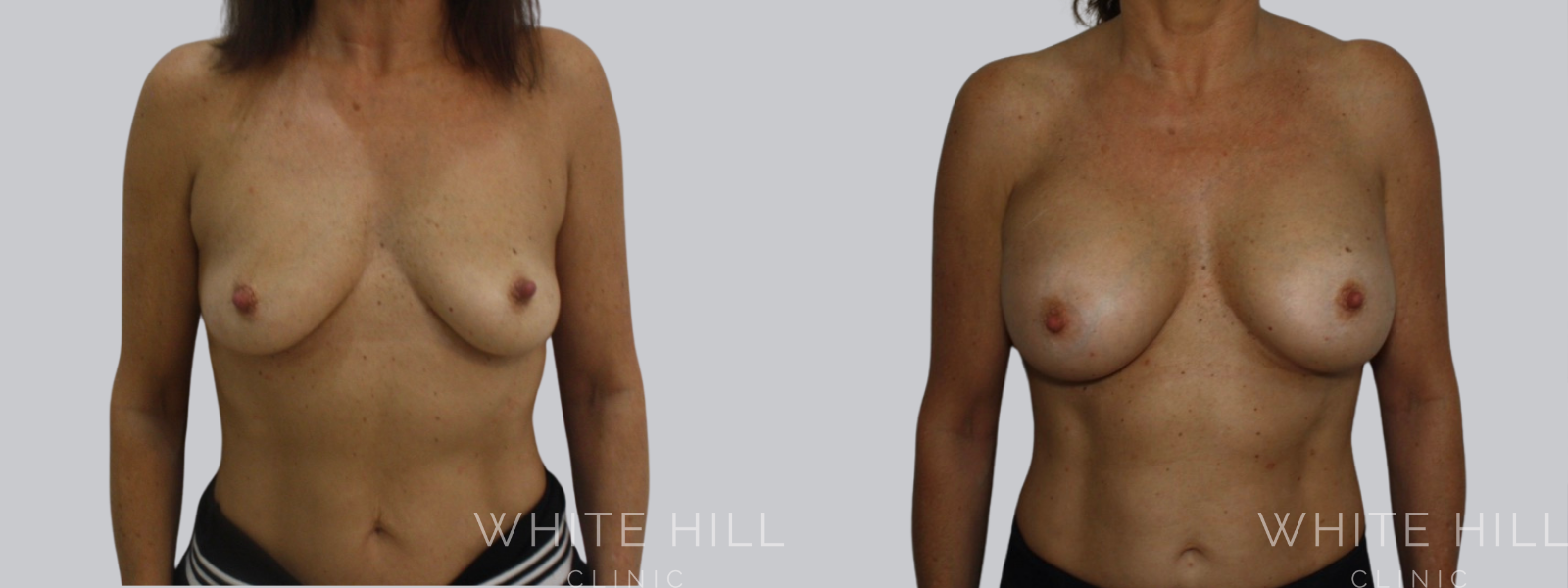 Breast Enhancement Sydney White Hill Clinic