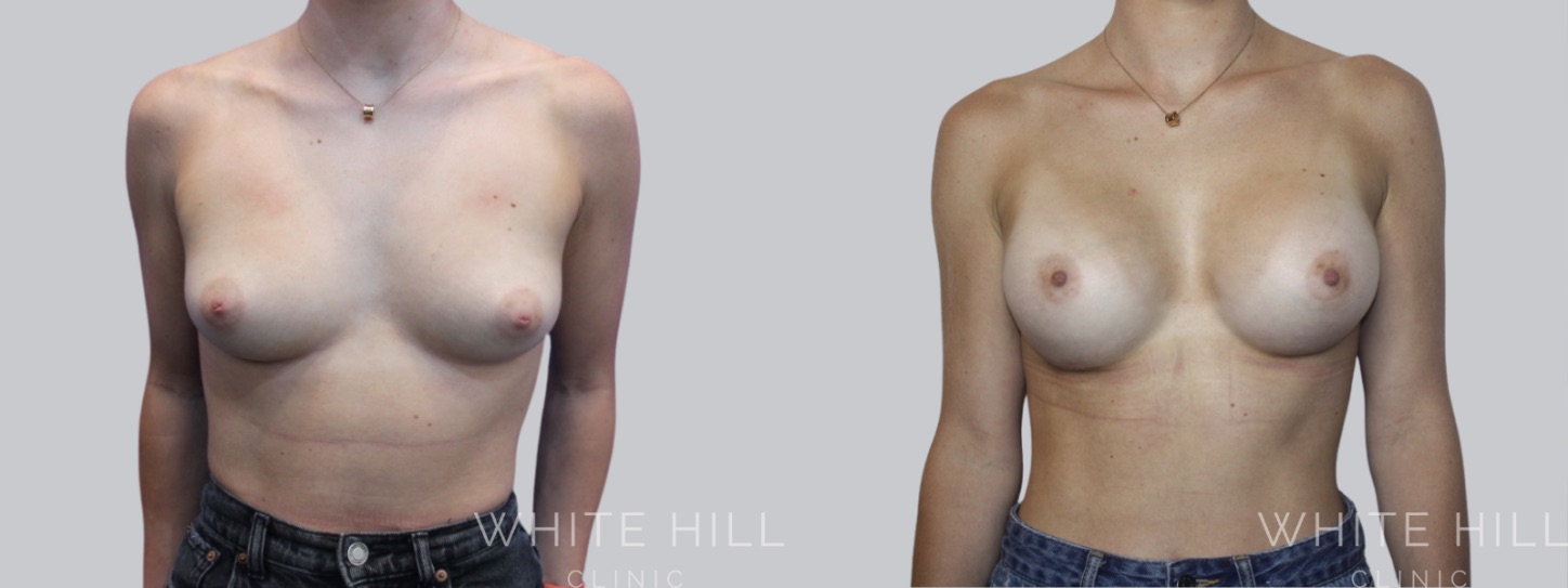 Breast Enhancement Sydney White Hill Clinic