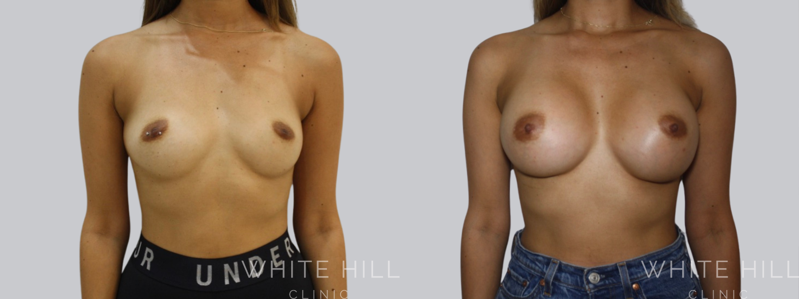 Breast Enhancement Sydney White Hill Clinic