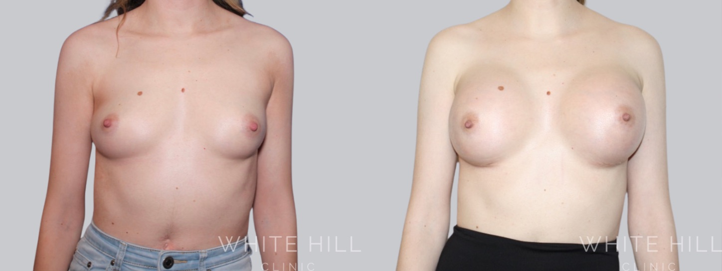 Breast Enhancement Sydney White Hill Clinic