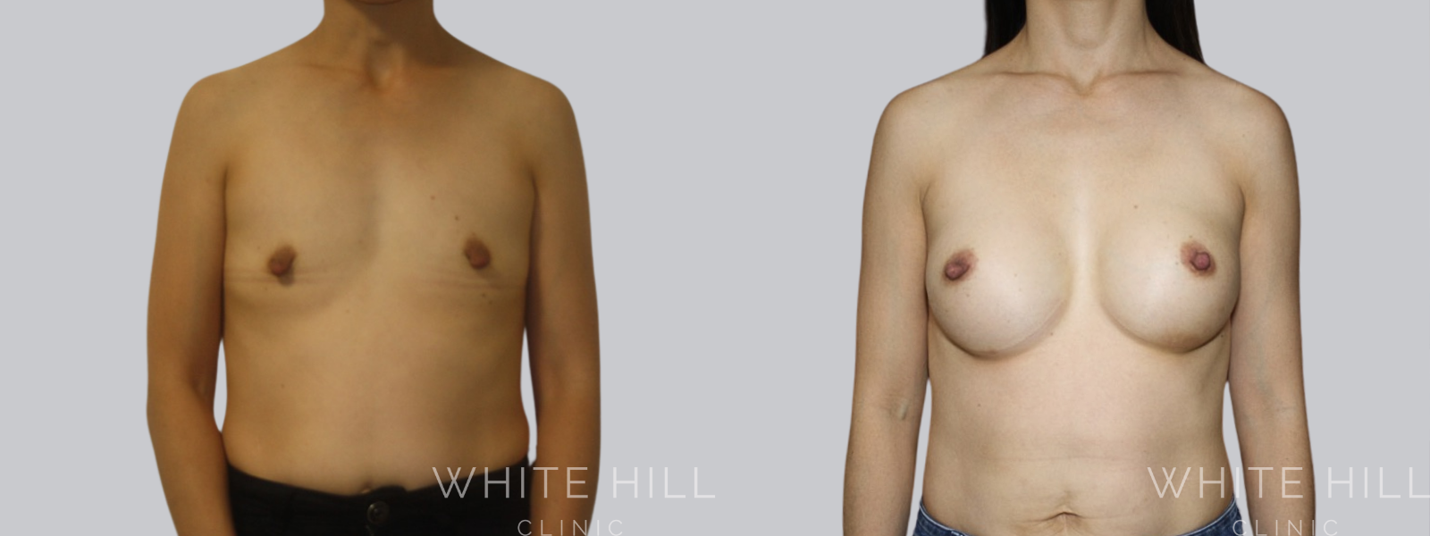 Breast Enhancement Sydney White Hill Clinic