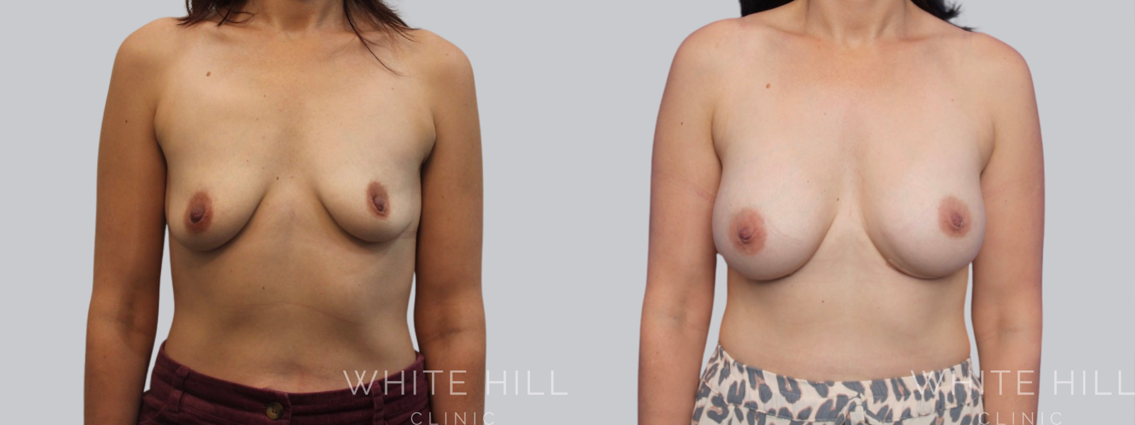 Breast Enhancement Sydney White Hill Clinic