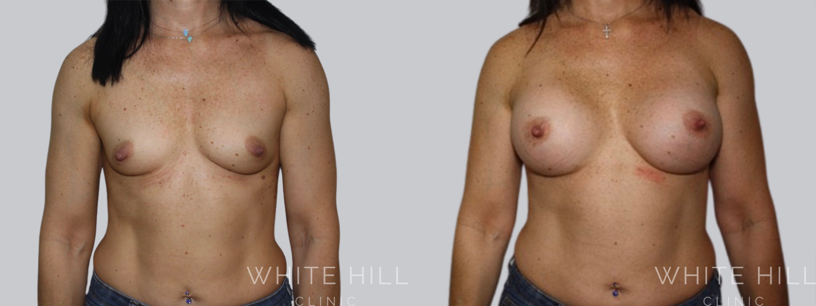 Breast Enhancement Sydney White Hill Clinic