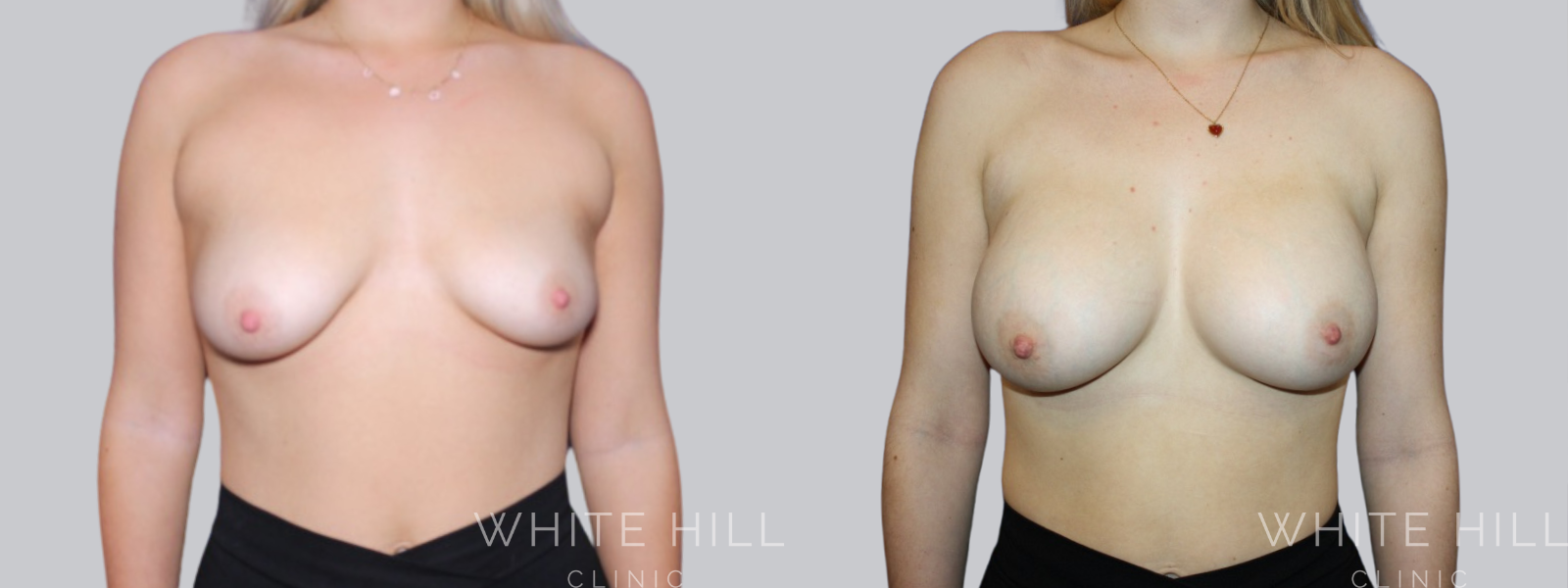 Breast Enhancement Sydney White Hill Clinic