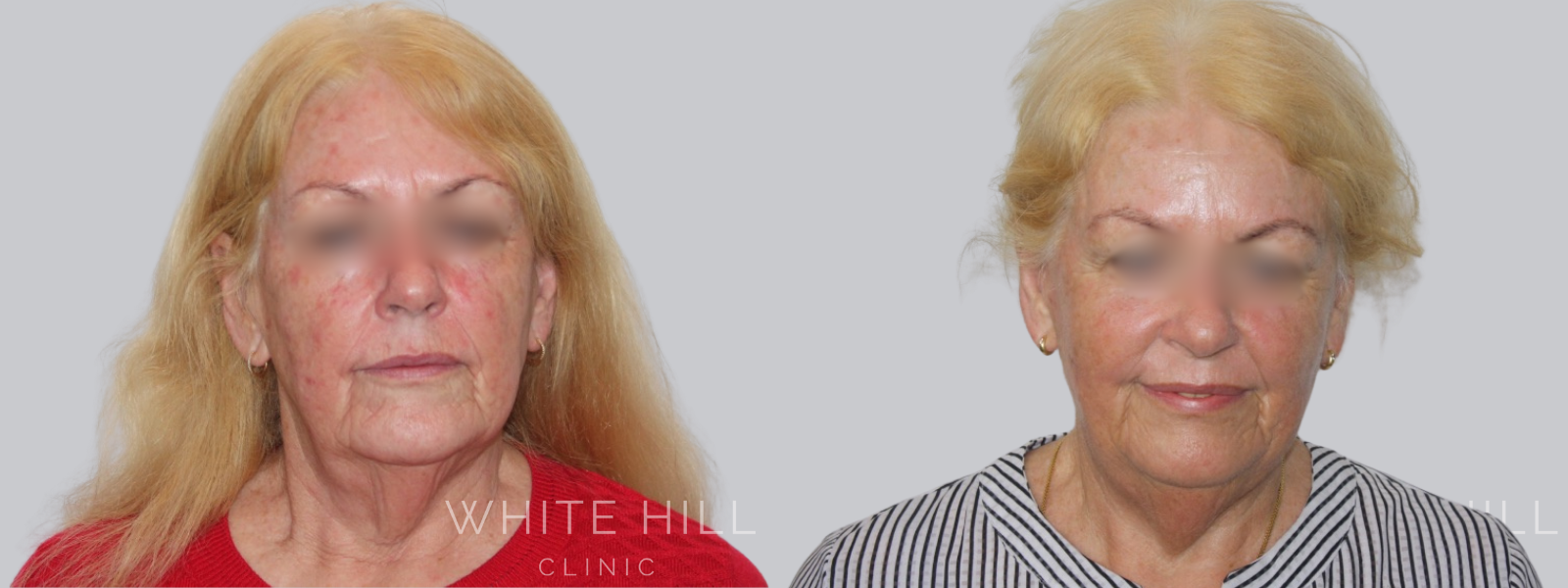 Facelift Surgery Sydney Before and After - White Hill Clinic