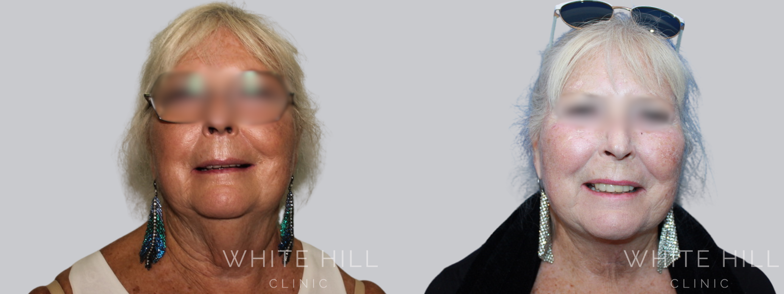 Facelift Before & After White Hill Clinic