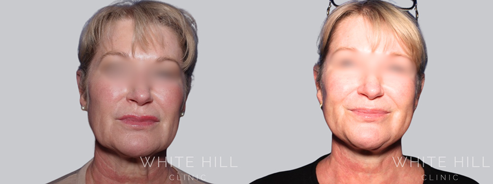 Facelift Before & After White Hill Clinic