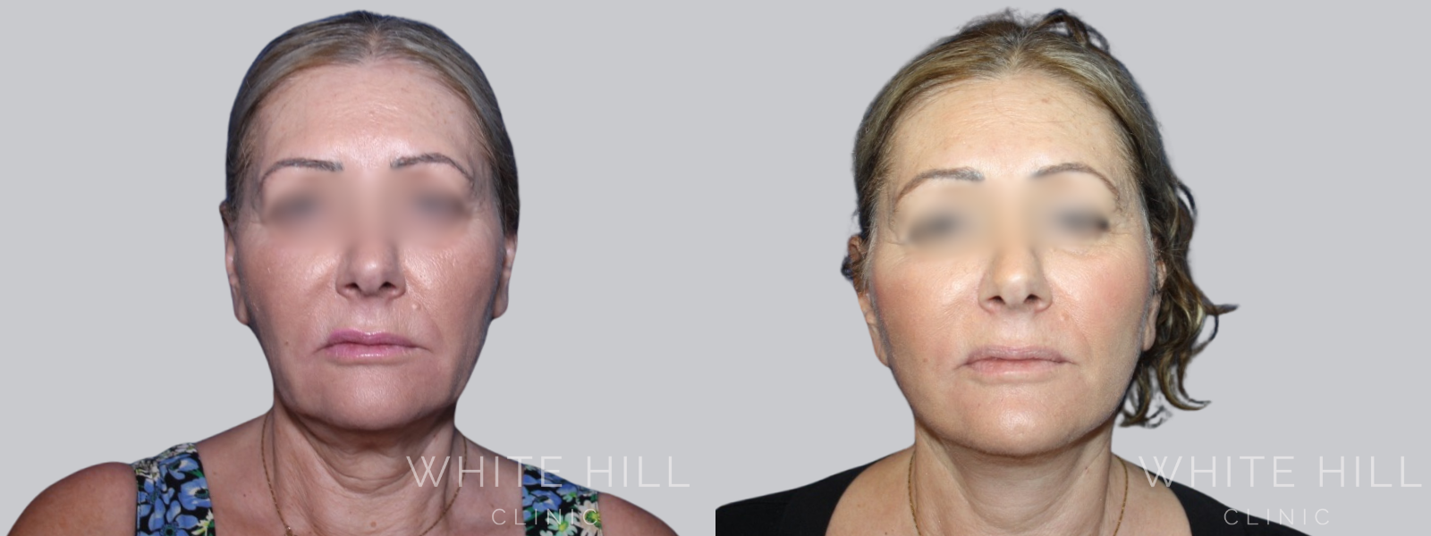 Facelift Before & After White Hill Clinic