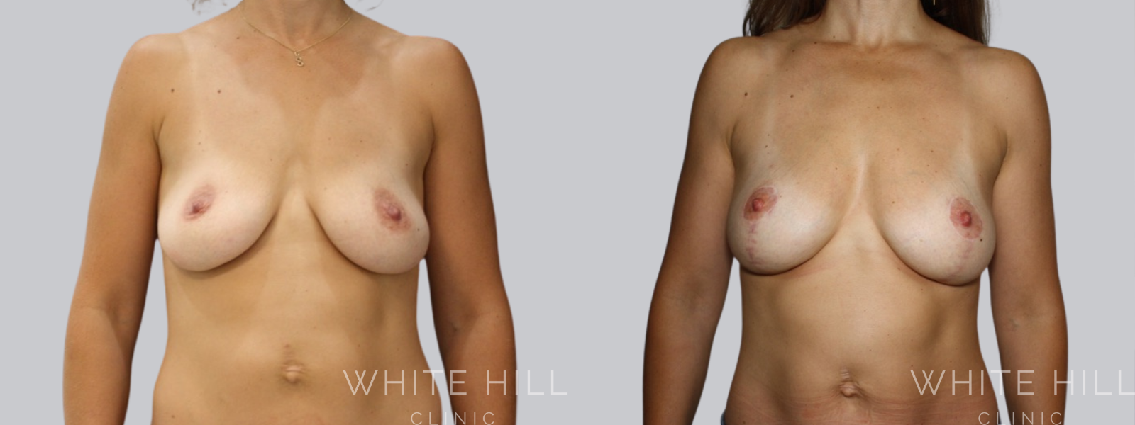 Fat Transfer Breast Augmentation Before and After Sydney White Hill Clinic