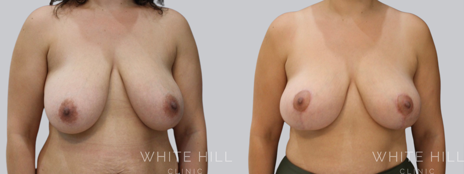 Fat Transfer Breast Augmentation Before and After Sydney White Hill Clinic