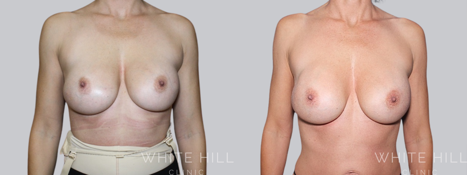 Fat Transfer Breast Augmentation Before and After Sydney White Hill Clinic