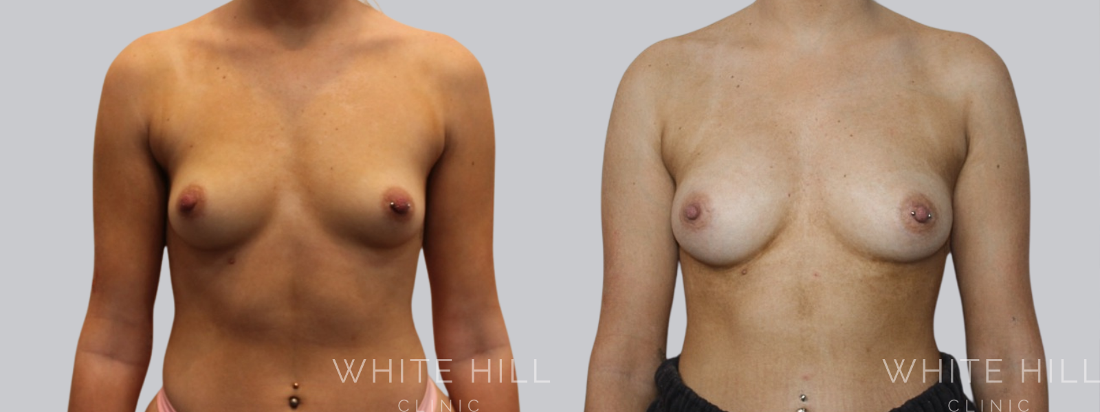 Fat Transfer Breast Augmentation Before and After Sydney White Hill Clinic