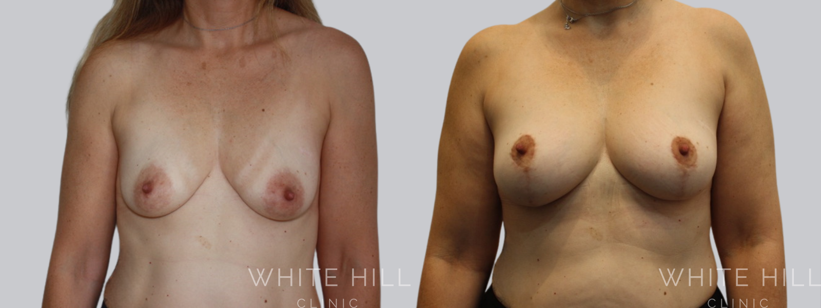 Fat Transfer Breast Augmentation Before and After Sydney White Hill Clinic