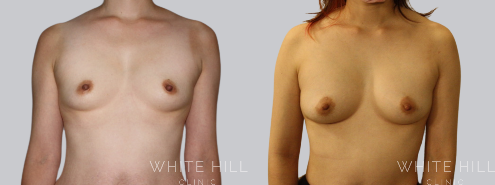 Fat Transfer Breast Augmentation Before and After Sydney White Hill Clinic