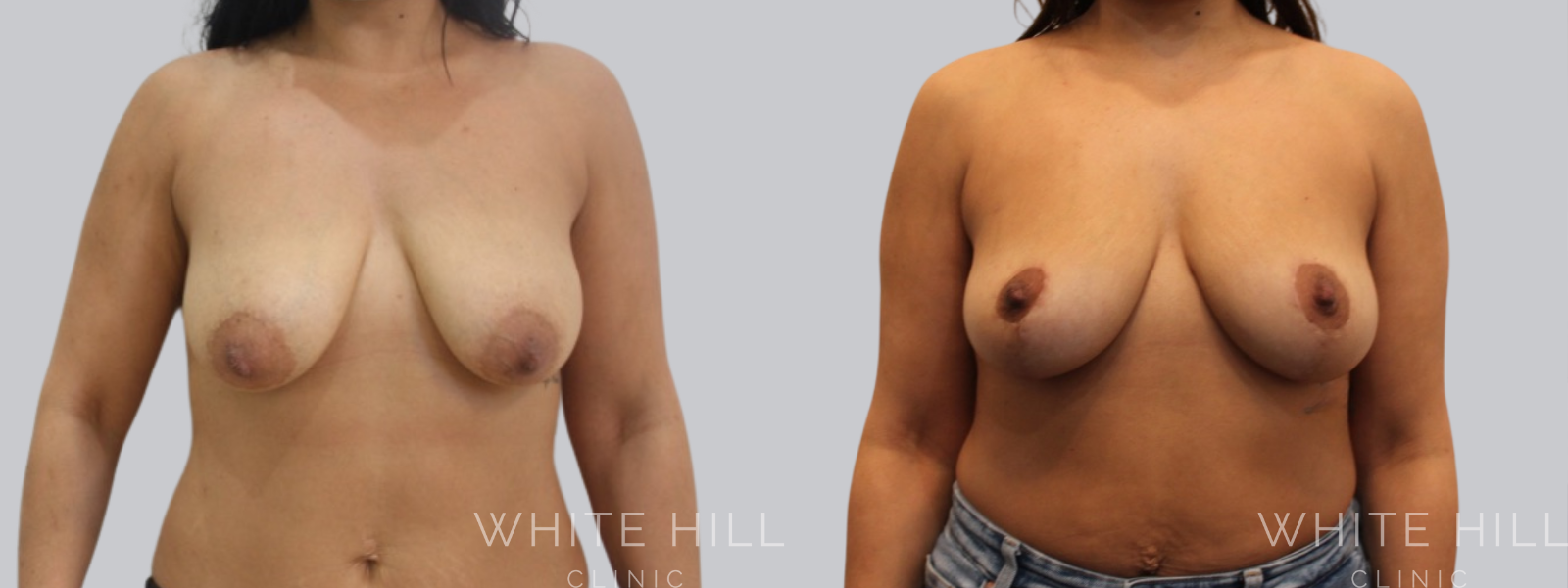 Fat Transfer Breast Augmentation Before and After Sydney White Hill Clinic