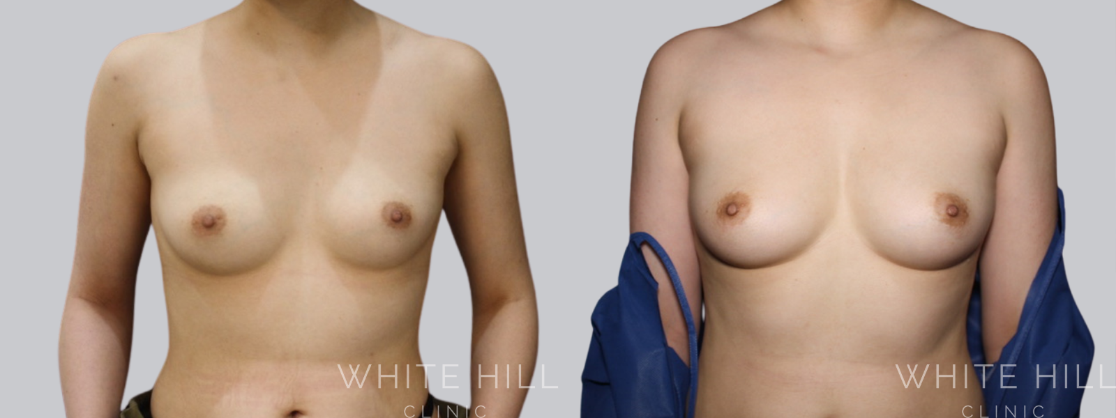 Fat Transfer Breast Augmentation Before and After Sydney White Hill Clinic