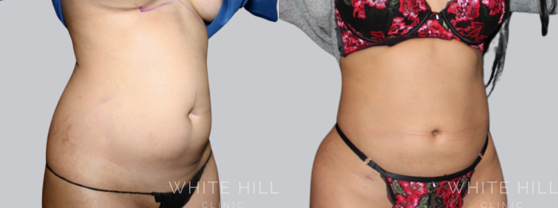 Liposuction before after