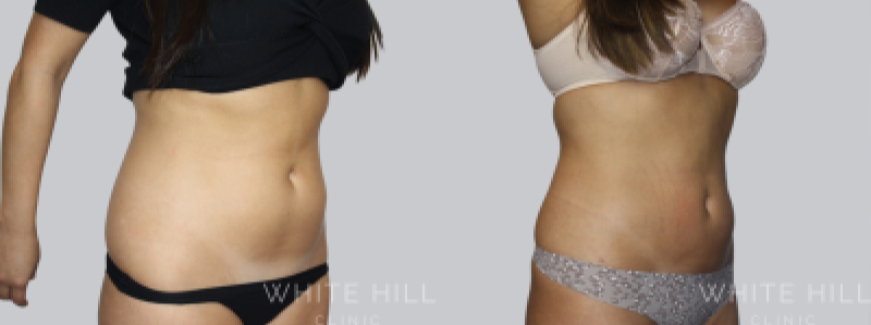 Liposuction before after