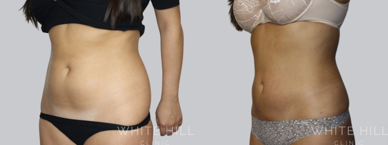 Liposuction before after