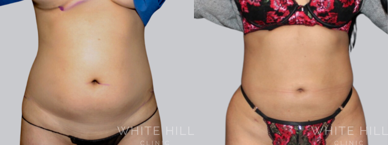 Liposuction before after