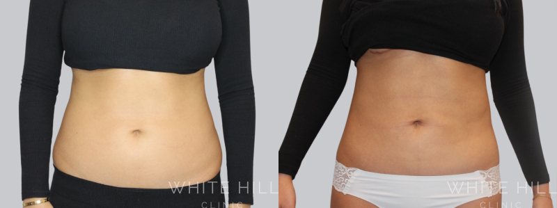 Liposuction before after