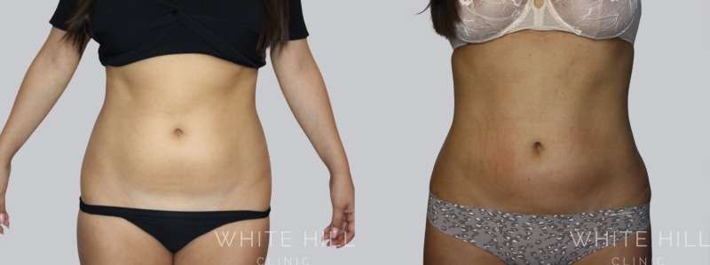 Liposuction before after